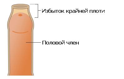 Фимоз – симптомы, причины, признаки заболевания, диагностика и лечение в «СМ-Клиника»