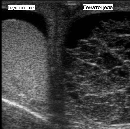 Распухло яйцо у мужчины. Придатки яичек у мужчин УЗИ. Воспаление придатка яичка на УЗИ.