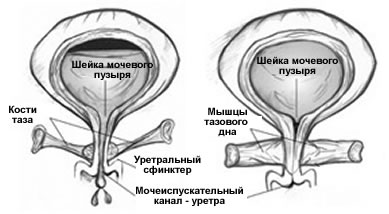 Вид мочевого пузыря. Слабые мышцы тазвого дна непрепятствуют вытеканию мочи (слева). Сильные мышцы тазового дна предупреждают её подтекание (справа)