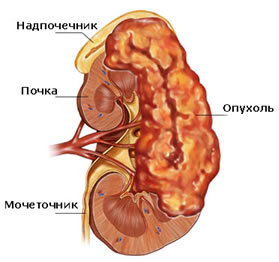 T3 — опухоль почки распространяется по крупным венам или прорастает в надпочечник или окружающую клетчатку, но не выходит за пределы фасции Герота ( фиброзная капсула, которая окружает почки и отделяет их от прилегающих мышц )