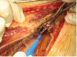 Люмботомический открытый хирургический доступ при резекции почки