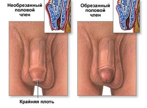 Вид полового члена до обрезания и после обрезания