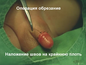 Операция "обрезание"