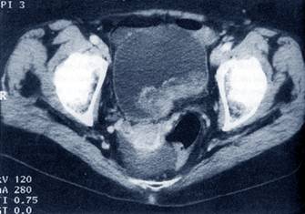 Компьютерная томография (КТ) малого таза и мочевого пузыря в диагностике рака мочевого пузыря