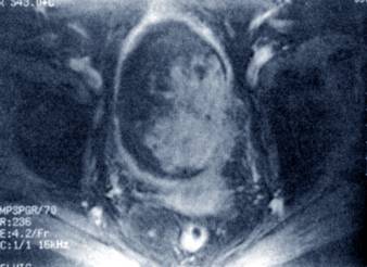 Магнитно-резонансная томография (МРТ) малого таза и мочевого пузыря в диагностике рака мочевого пузыря