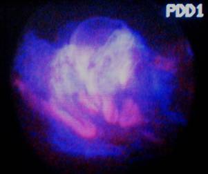 Фотодинамическая диагностика рака мочевого пузыря