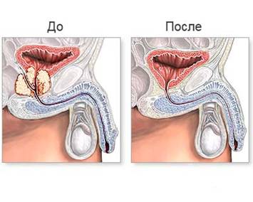 Состояние органов малого таза до и после простатэктомии