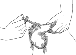Лечение импотенции - инъекции через специальную иглу в пенис