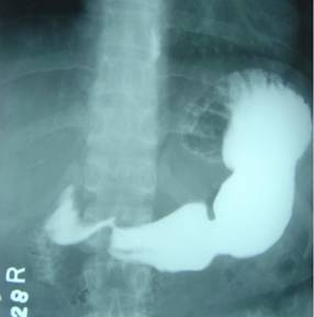 Рентгеноскопия желудка с барием — один из мотодов диагностики нефроптоза