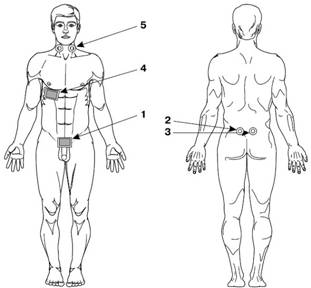 Зоны воздействия при лазерной терапии заболеваний органов урогенитальной области у мужчин (простатит)