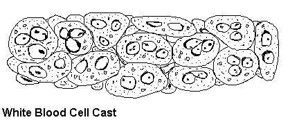 Лейкоцитарный цилиндр в моче