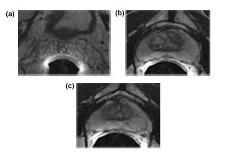 Аксиальная T2-взвешенная магнитно-резонансная томограмма нормальной простаты