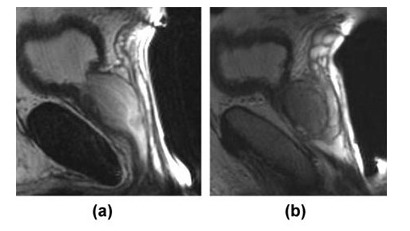 Саггитальные T2- взвешенные магнитно-резонансные томограммы (a, b) нормальной предстательной железы