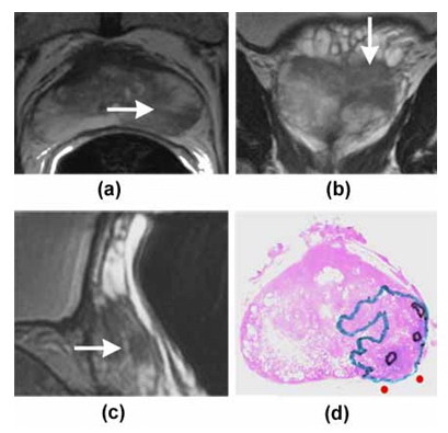 На T2-взвешенных магнитно-резонансных томограммах стрелками показаны области с низкой интенсивностью сигнала, которые подозрительны на рак простаты