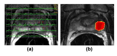 Аксиальные T2-взвешенные МРТ изображения с наложением магнитно-резонансной спектроскопической сетки