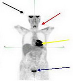 Это изображение представляет нормальную позитронно-эмиссионную томографию (ПЭТ) с использованием глюкозы (сахара), меченной Фтором 18
