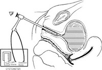 Динамическая уретроскопия выполняется с использованием уретроскопа с прикрепленным цистометром со средой растяжения и источником света