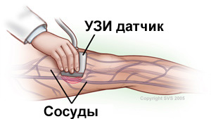 Исследование артерии рук и ног с помошью доплер УЗИ