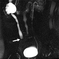 Сдавление правого мочеточника    аппендикулярным инфильтратом (магнитно-резонансная урография)