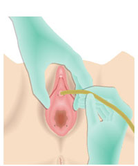 Введение катетера в уретру у женщины