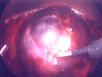 Лапароскопическое удаление опухоли с использованием аблации