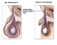 Водянку яичка лечат  при помощи пункции или посредством операции