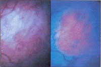 Фотодинамическая диагностика во время эндоскопического удаления поверхностного рака мочевого пузыря снижает риск развития рецидива опухоли