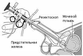 Трансуретральная резекция предстательной железы