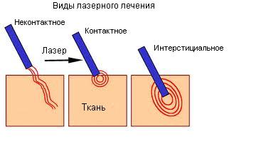 Интерстициальная лазерная терапия