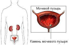Камни мочевого пузыря