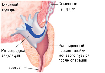 Эякуляция (семяизвержение)