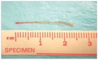 Длина и диаметр  столбиков  при биопсии  простаты